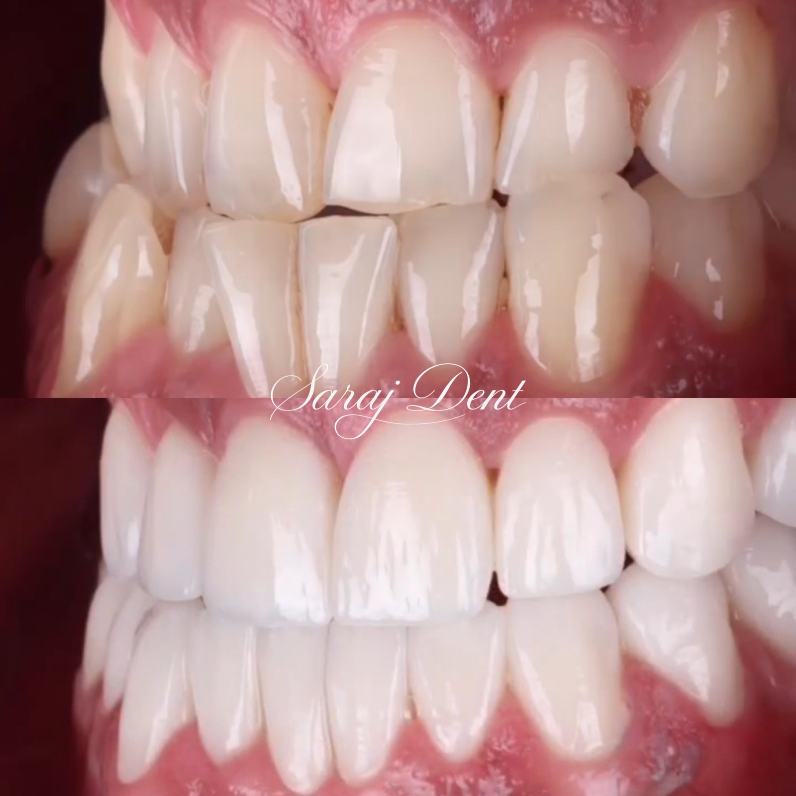 Before and after progenia treatment at Saraj Dent in Sarajevo, showing reverse bite correction, improved facial profile harmony, and a stable functional bite.