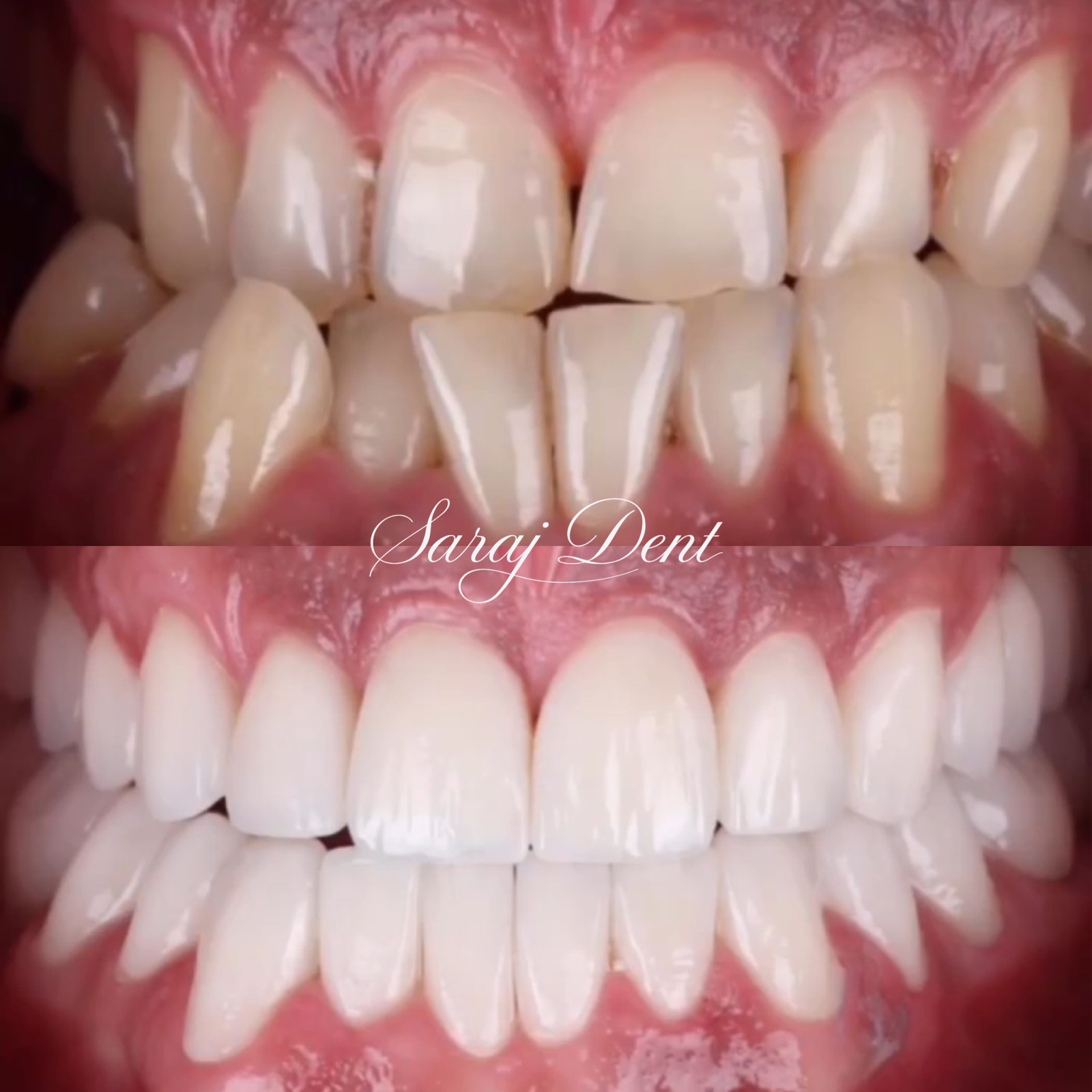 Before and after progenia treatment at Saraj Dent in Sarajevo, showing reverse bite correction, improved facial profile harmony, and a stable functional bite.