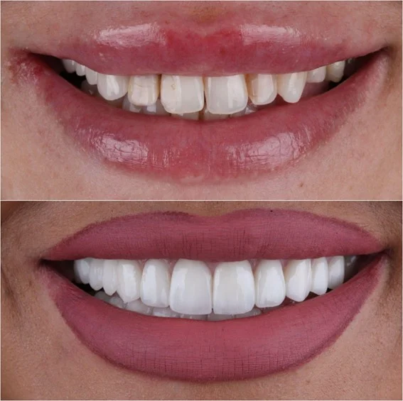 Hollywood smile Sarajevo – Prirodna transformacija osmijeha