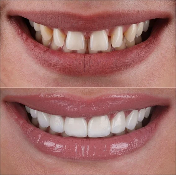 Pregled i procjena za Hollywood smile