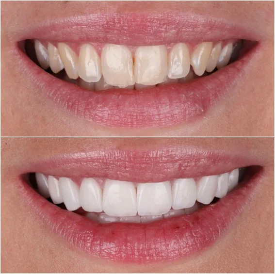 Prirodan izgled Hollywood smile osmijeha