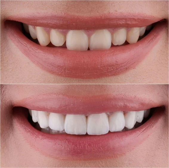 Hollywood Smile Sarajevo – Viniri, Luminiri i Keramičke Navlake | Saraj Dent