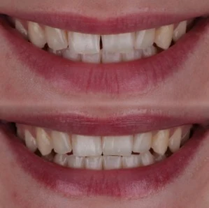 Kompozitne nadopune: precizna i prirodna korekcija osmijeha | Saraj Dent