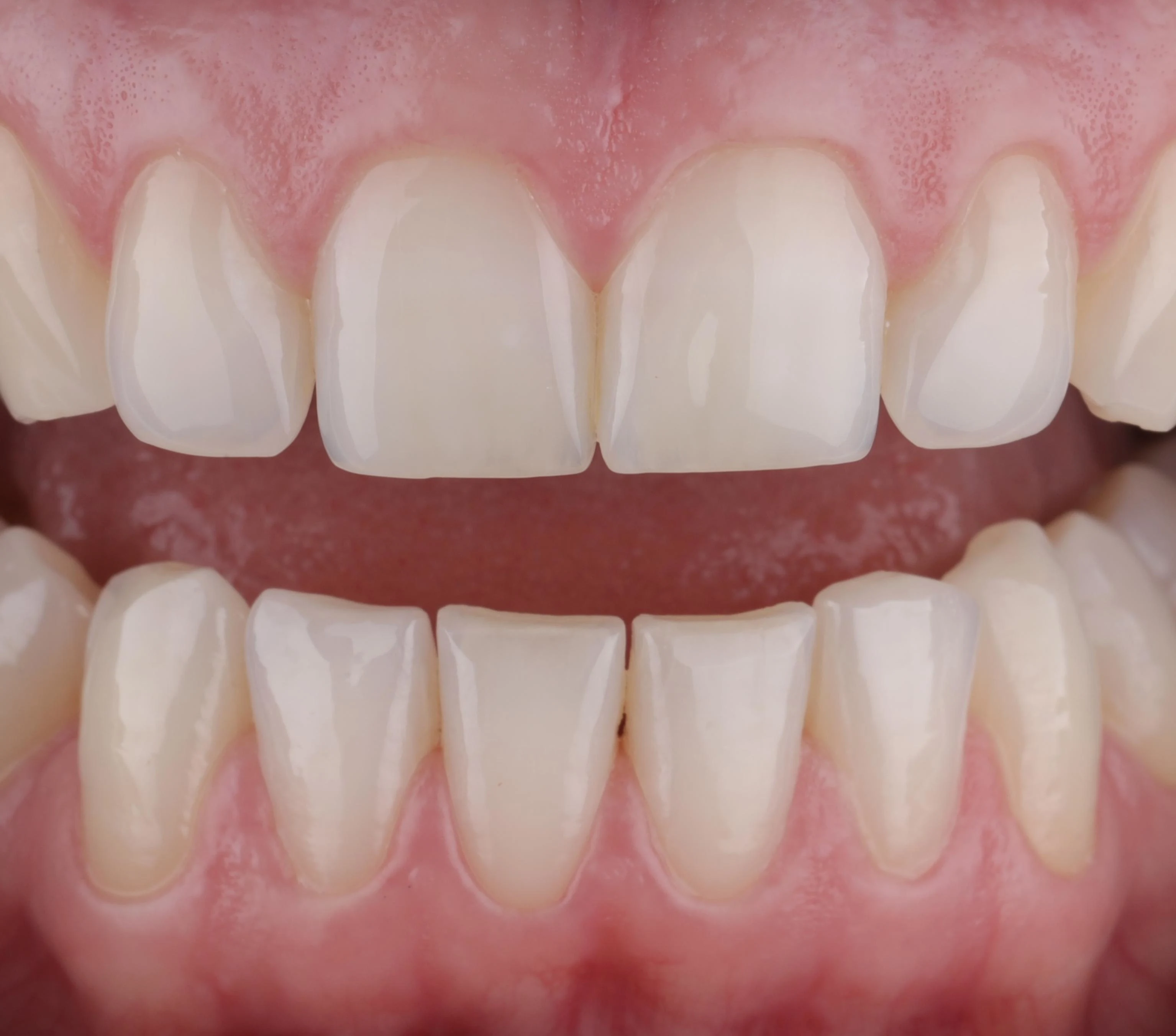 Osjetljivi zubi: uzroci i prevencija