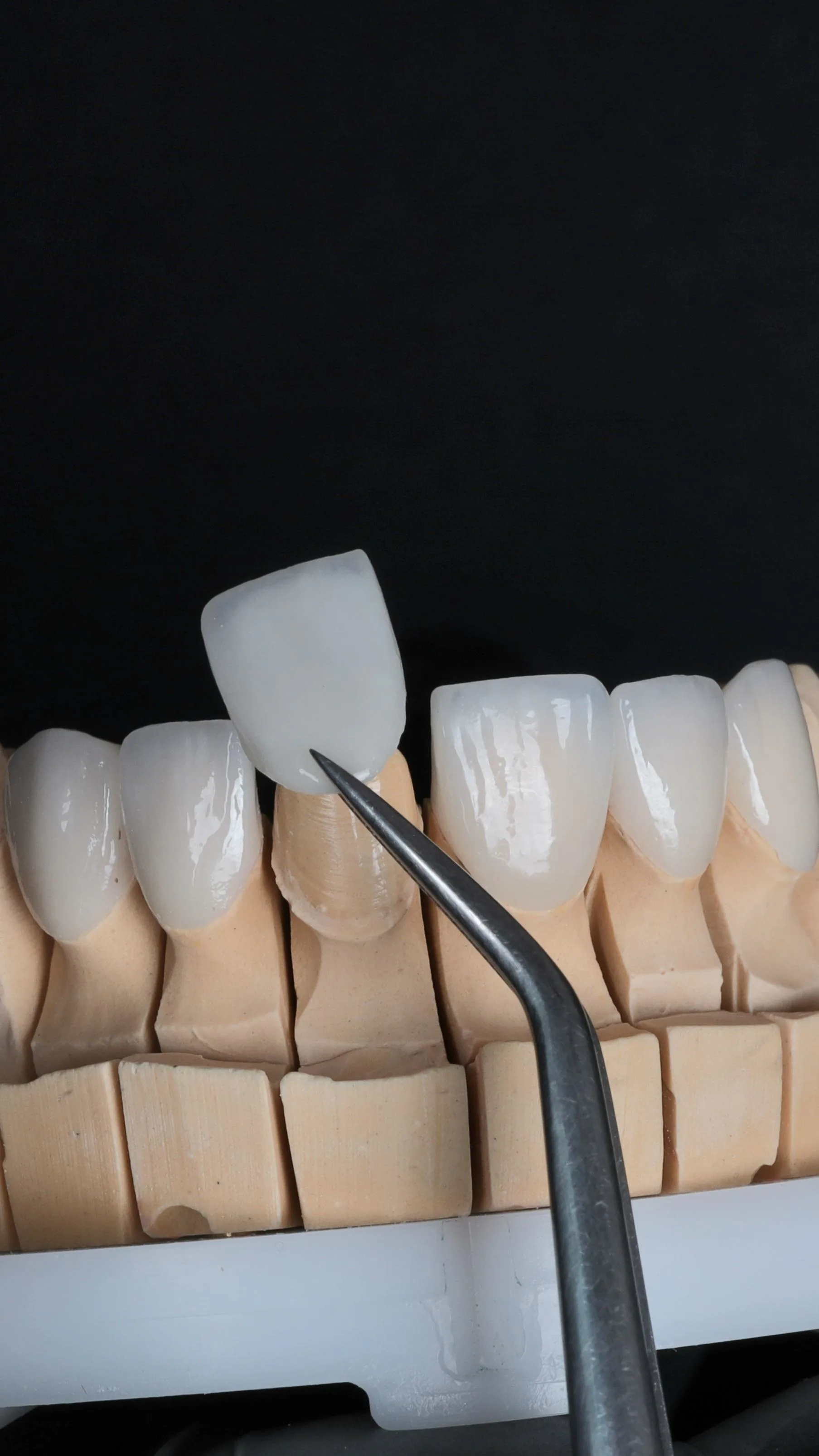 Transformacija osmijeha uz vinire