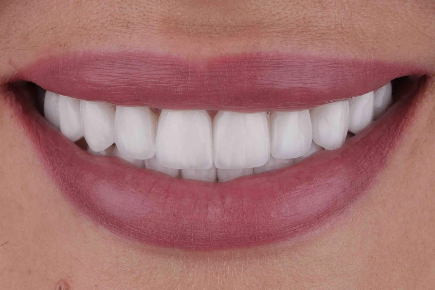 Savršen osmijeh uz vinire – Hollywood smile