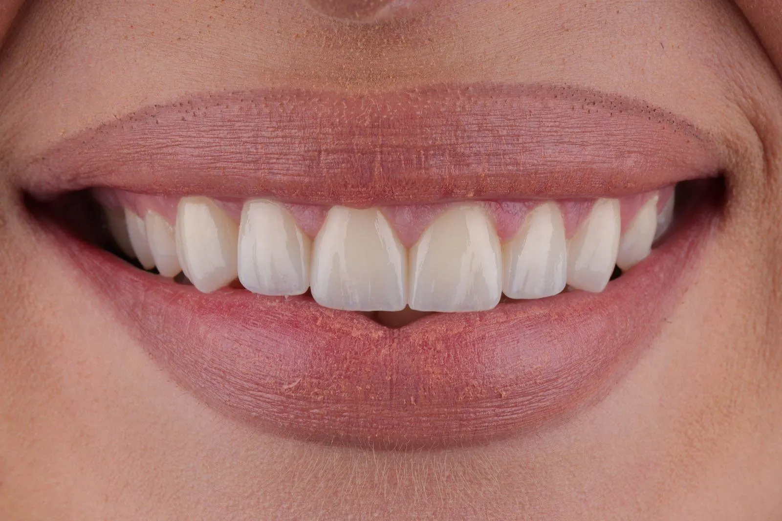 Viniri Sarajevo – transformacija osmijeha prije i poslije